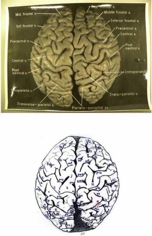 right hemisphere of the brain
